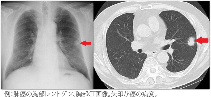 例：肺癌の胸部レントゲン、胸部CT画像。矢印が癌の病変。