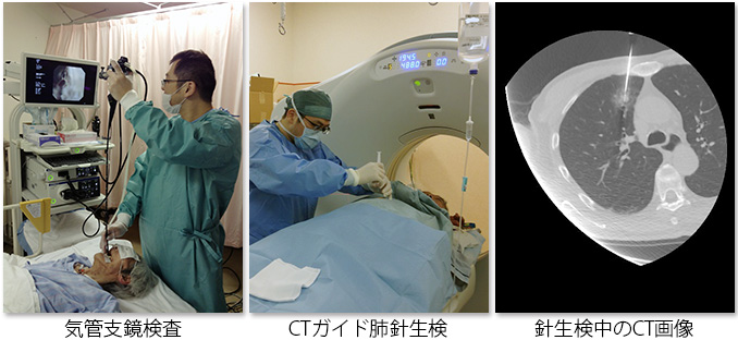 気管支鏡検査 CTガイド下肺生検：CTを見ながら肺病変まで針を進めて組織を採取します。