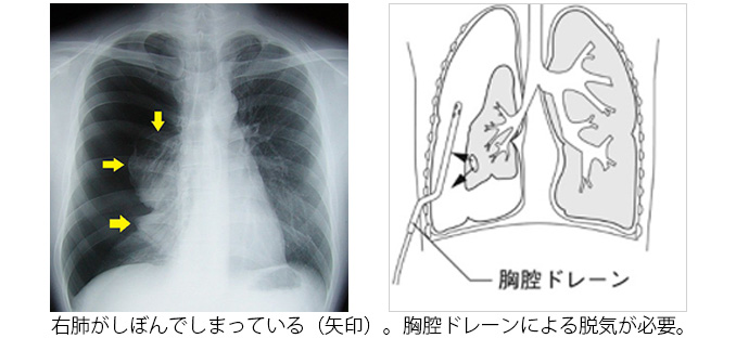 右肺がしぼんでしまっている（矢印）。胸腔ドレーンによる脱気が必要。