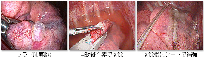 ブラ（肺嚢胞） 自動縫合器で切除 切除後にシートで補強
